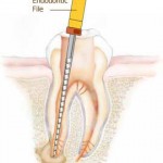 Root Canal