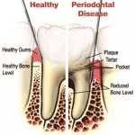 Periodontal Therapy