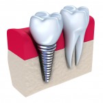Implants