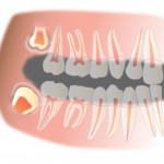 Wisdom Teeth